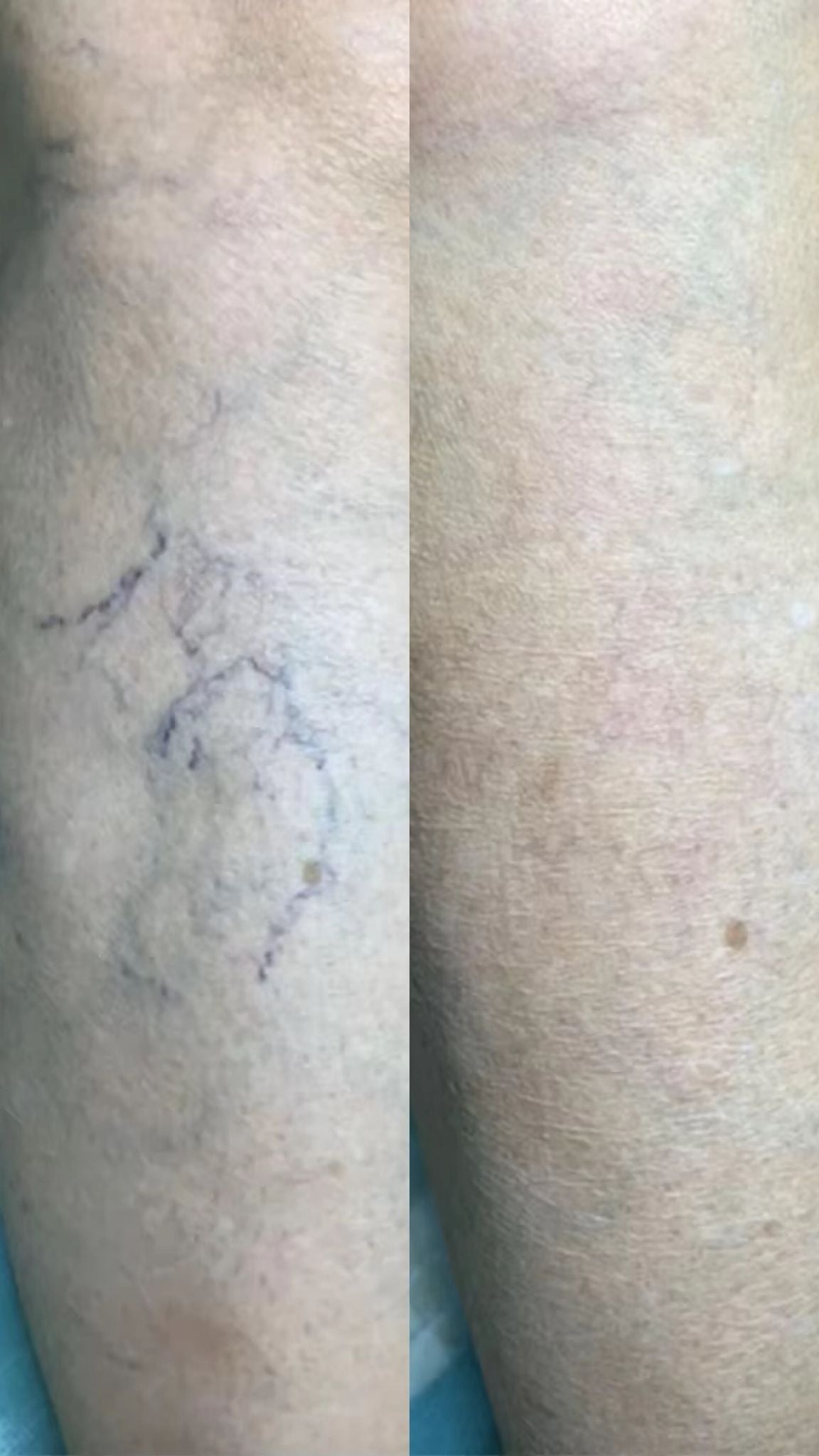 VeinSync Pro Venen-Behandlungsstift