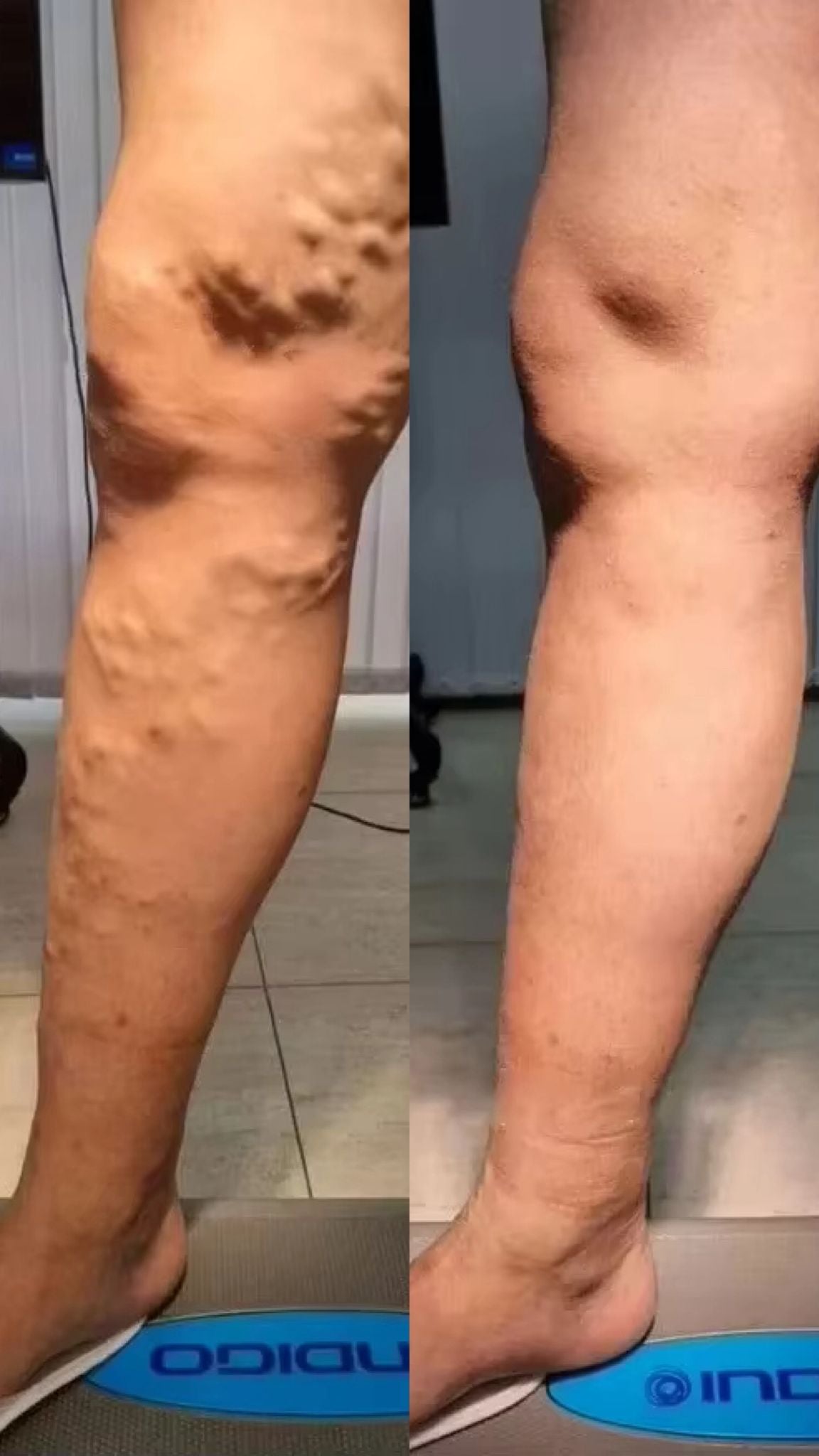 VeinSync Pro Venen-Behandlungsstift